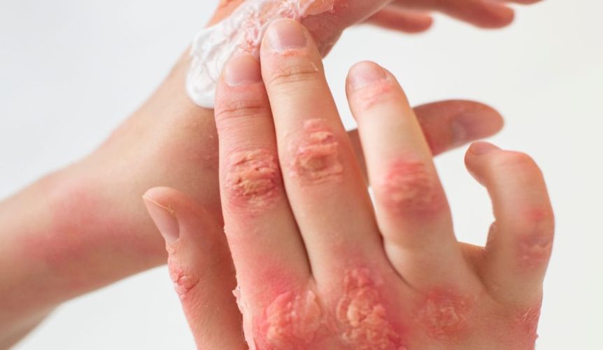 Come richiedere il risarcimento per dermatite professionale